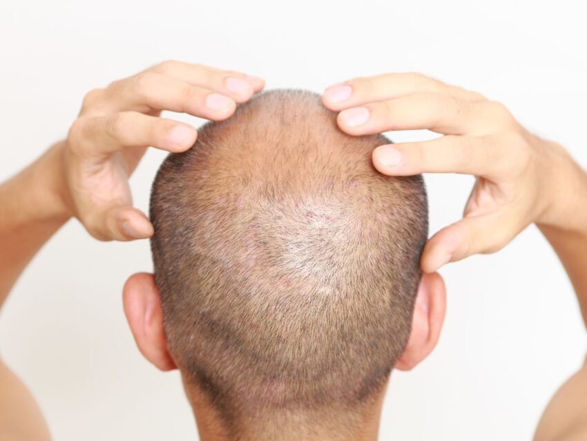 Natural Remedies for Male Pattern Baldness